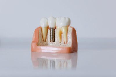 model of how dental implants are placed