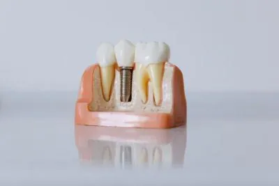 model of how dental implants are placed